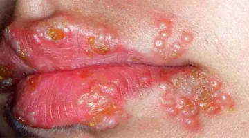علامات فيروس الهربس لدى الأطفال ووسائل الوقاية منه