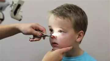 لحمية الأنف عند الأطفال: متى تصبح خطرًا وتتطلب تدخلًا سريعًا؟