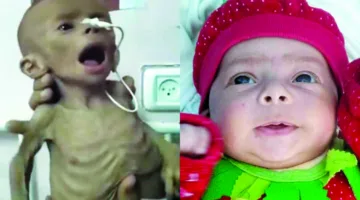 زينب أبو حليب: طفلة لم تختبر من الحياة سوى ألم الجوع