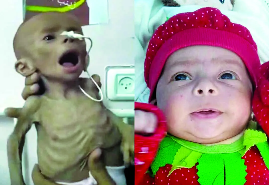 زينب أبو حليب: طفلة لم تختبر من الحياة سوى ألم الجوع