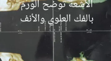 بموافقة وزارة الصحة.. إزالة ورم معقد من وجه سيدة في مستشفى قنا العام