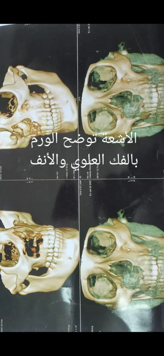 بموافقة وزارة الصحة.. إزالة ورم معقد من وجه سيدة في مستشفى قنا العام بموافقة وزارة الصحة.. إزالة ورم معقد من وجه سيدة في مستشفى قنا العام