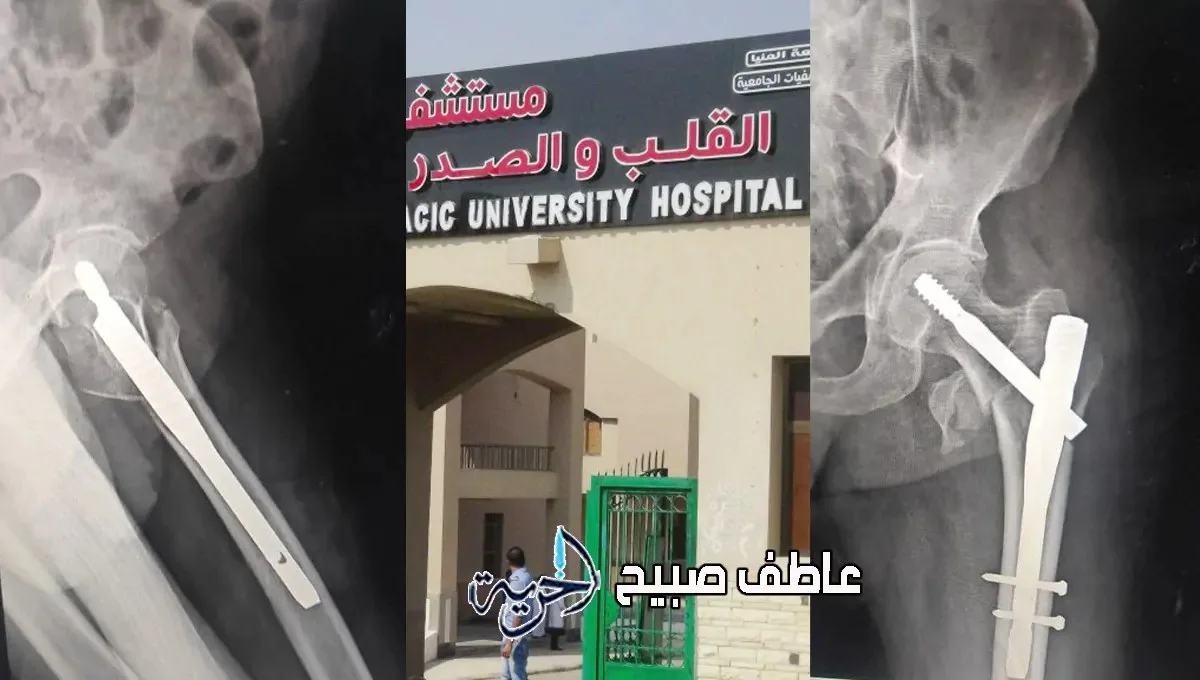 مستشفى الصدر في المنيا ينفذ جراحة معقدة لإنقاذ رجل مسن يبلغ من العمر 110 سنوات. مستشفى الصدر في المنيا ينفذ جراحة معقدة لإنقاذ رجل مسن يبلغ من العمر 110 سنوات.