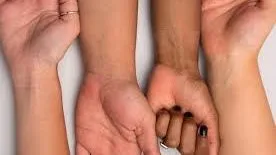 3 مشكلات صحية تسبب اسمرار البشرة .. تأكد من صحتك