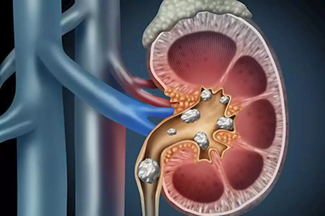 4 علاجات طبيعية تساعدك في التخلص من حصوات الكلى