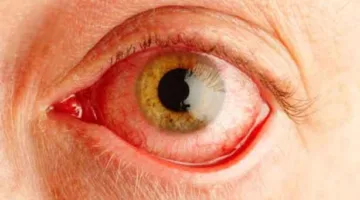 5 مشاكل صحية خطيرة يمكن أن يدل عليها احمرار العين