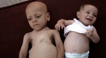 وسط الحصار في غزة.. الجوع والمرض يؤثران على صحة عبد الله وحبيبة