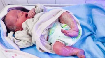 ولادة طفل بحالة طبية غير شائعة في الفيوم