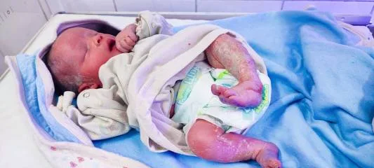 ولادة طفل بحالة طبية غير شائعة في الفيوم