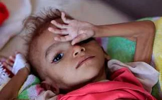 الأمم المتحدة: أكثر من 17 مليون فرد يعانون من نقص الغذاء في اليمن