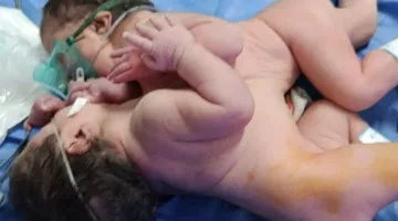 إجراء عملية ولادة نادرة بتوائم ملتصقة في مستشفى الفيوم العام