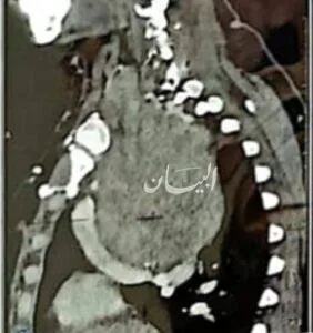 نجاح جراحة معقدة في مستشفى كفر الشيخ الجامعي نجاح جراحة معقدة في مستشفى كفر الشيخ الجامعي
