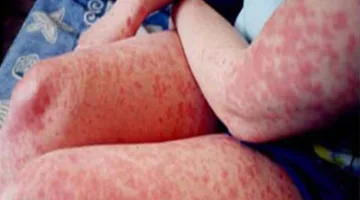 موت امرأة في الثانية والثمانين من عمرها في إيطاليا بسبب عدوى فيروس غرب النيل