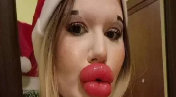 بسبب شكلها… المرأة ذات أكبر شفاه في العالم تُمنع من العلاج
