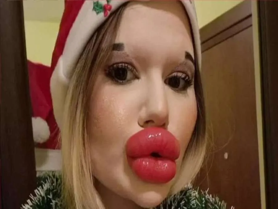 بسبب شكلها… المرأة ذات أكبر شفاه في العالم تُمنع من العلاج بسبب شكلها… المرأة ذات أكبر شفاه في العالم تُمنع من العلاج