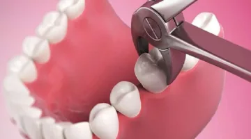 هل يوجد تعويض مالي في حال تم قلع السن بالخطأ؟