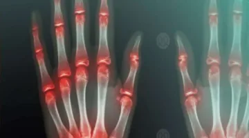 تخلص من آلام المفاصل خلال 8 أسابيع.. تمارين سهلة تحدث تغييراً ملحوظاً
