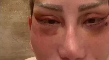 أطباء يحذرون من مخاطر جراحات التجميل التي تؤدي إلى تشوهات دائمة