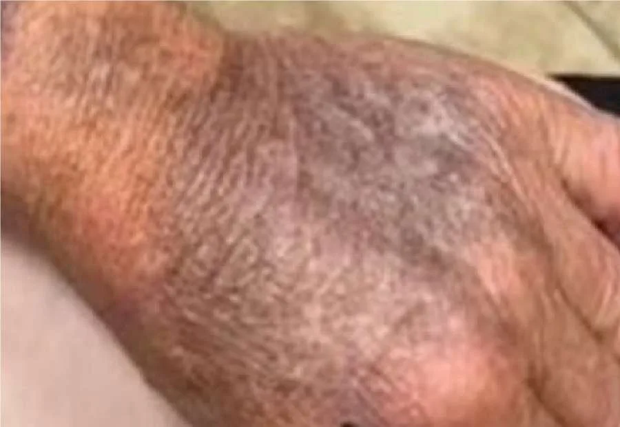 لا تتجاهل واقي الشمس مجددًا.. مشاهد مدهشة تكشف المخاطر.