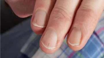 علامات على أظافرك قد تشير إلى خطر الإصابة بأمراض القلب.. كن حذرًا!
