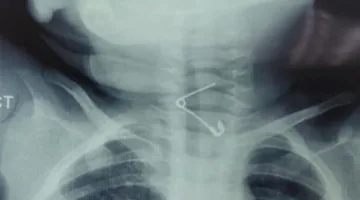 إنقاذ حياة طفل بعد است swallowing دبوس معدني في مستشفى أطفال بنها بالقليوبية.. صور