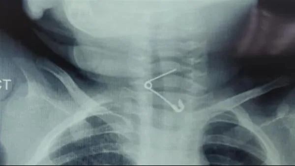 إنقاذ حياة طفل بعد است swallowing دبوس معدني في مستشفى أطفال بنها بالقليوبية.. صور