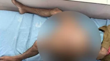 استئصال ورم زنة 35 كيلوغراماً من ساق رجل هندي