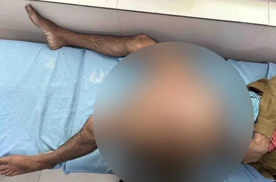 استئصال ورم زنة 35 كيلوغراماً من ساق رجل هندي استئصال ورم زنة 35 كيلوغراماً من ساق رجل هندي