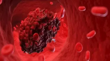 انتبه.. هذه العلامات تشير إلى وجود جلطات دموية في الساقين