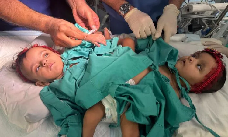 انطلاق عملية فصل التوأم السعودي الملتصق ‘يارا ولارا’ التي ستستغرق حوالي 15 ساعة