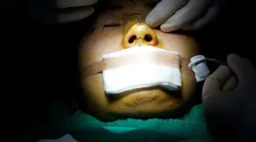 تصحيح شكل الأنف دون جراحة… متى يكون مناسبًا؟