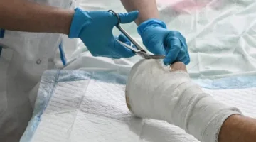 تطوير طلاء مضاد للبكتيريا لتحسين أداء الغرسات القابلة للتحلل الحيوي