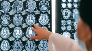 دراسة تربط دواء مُستخدم لعلاج آلام الظهر بارتفاع مخاطر الإصابة بالخرف
