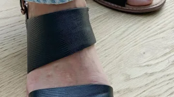 كيف تتعامل مع البثور الناتجة عن ارتداء الأحذية الصيفية؟