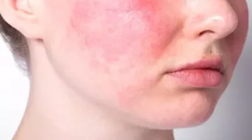 ما هي العوامل والأعراض ووسائل الوقاية من مرض “الوردية”؟