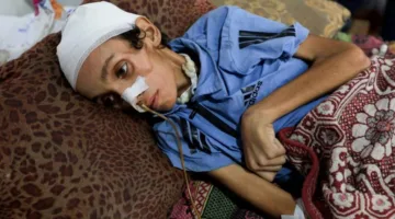 مقتل 21 طفلًا جوعًا في غزة خلال 72 ساعة