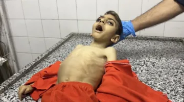 منظمة الصحة العالمية تحذر: سوء التغذية في غزة وصل إلى “معدلات مقلقة”