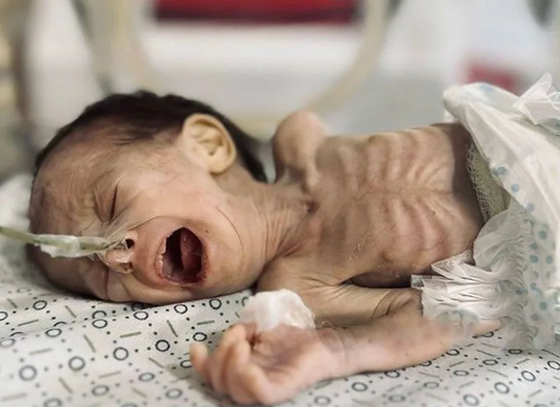 موت طفلة جراء الحصار الإسرائيلي في غزة
