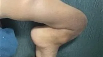 نجاح جراحي نادر لطفل مصاب باضطراب عظمي نادر بفضل فريق طبي في جامعة أسيوط بعد سنوات من المعاناة
