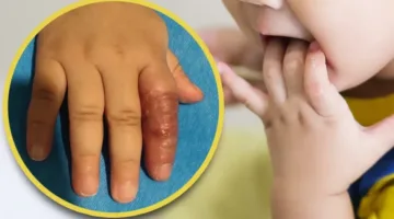 نصيحة خاطئة على الإنترنت تضر إصبع طفل رضيع