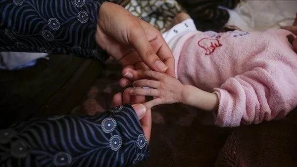 وفاة طفلة تبلغ من العمر سنة ونصف نتيجة نقص التغذية في قطاع غزة وفاة طفلة تبلغ من العمر سنة ونصف نتيجة نقص التغذية في قطاع غزة