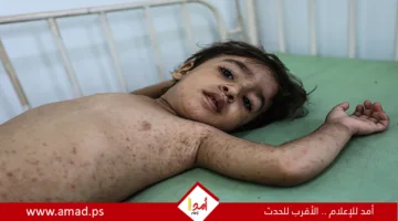 طبيبة هولندية تحذر: مرض تنفسي غير معروف يهدد سكان غزة خلال ساعات، و”الشلل” من أبرز علاماته.