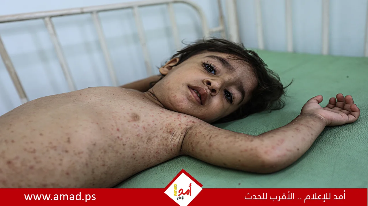 طبيبة هولندية تحذر: مرض تنفسي غير معروف يهدد سكان غزة خلال ساعات، و”الشلل” من أبرز علاماته. طبيبة هولندية تحذر: مرض تنفسي غير معروف يهدد سكان غزة خلال ساعات، و”الشلل” من أبرز علاماته.