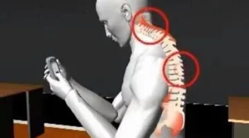 استشاري يكشف عن أسباب انحراف الفقرات لدى الأطفال.. ومتى يصبح التدخل الجراحي ضروريًا؟
