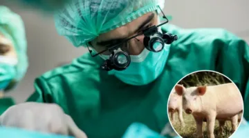 الصين تحقق إنجازًا كبيرًا: نجاح أول عملية زرع رئة خنزير في جسم إنسان