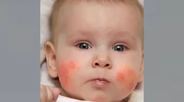4 توجيهات لتجنب الطفح الجلدي لدى الأطفال