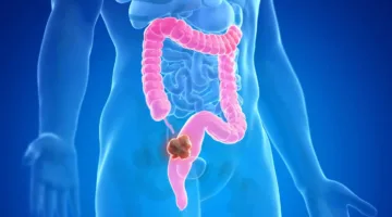 أطعمة تقلل من احتمال الإصابة بسرطان القولون بنسبة 20 بالمئة
