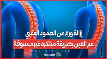 إزالة ورم من العمود الفقري من خلال العين بطريقة مبتكرة وغير تقليدية.. ماذا جرى؟