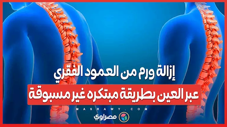 إزالة ورم من العمود الفقري من خلال العين بطريقة مبتكرة وغير تقليدية.. ماذا جرى؟