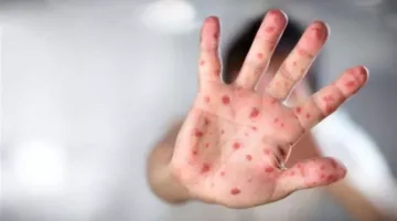 الحصبة تتصدر القائمة: ما هي أخطر وأشهر الأمراض في العالم؟